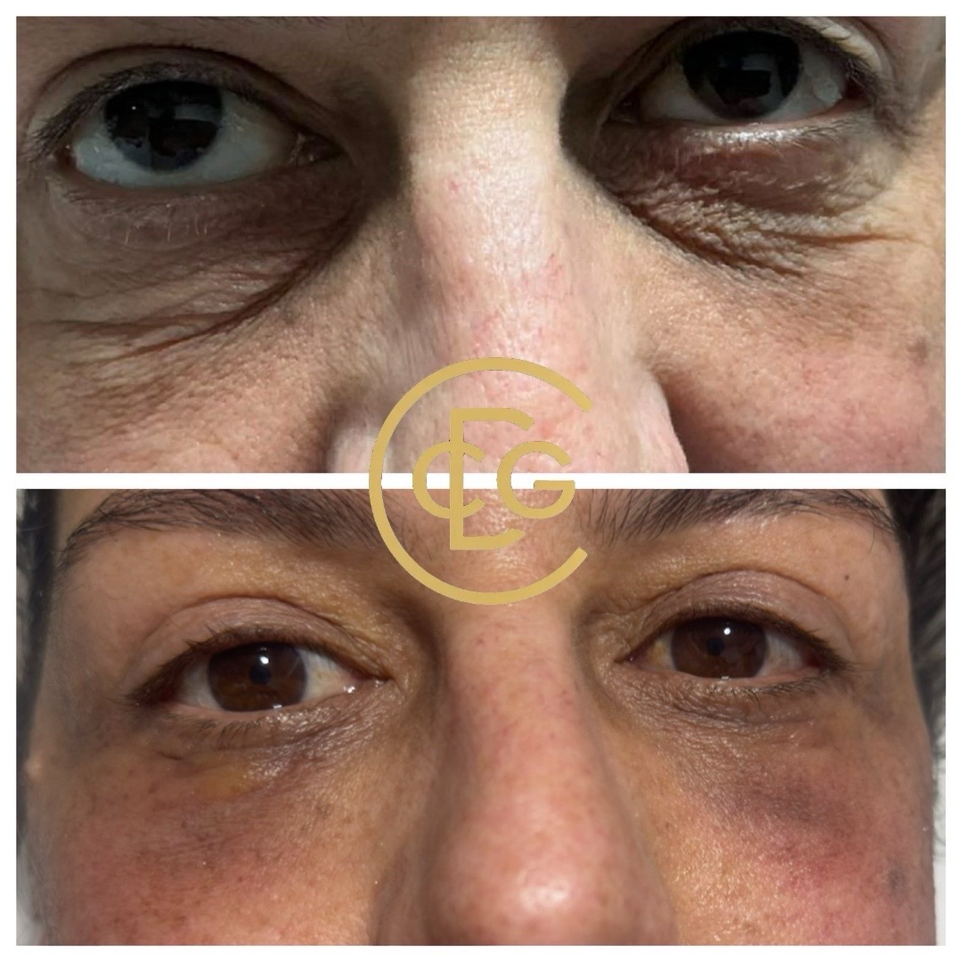 Endolift before and after — Under eye