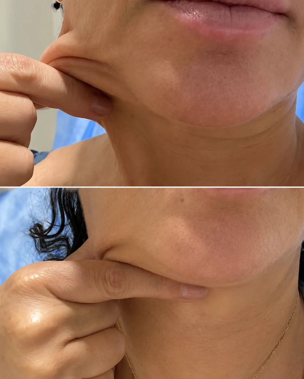 Endolift before and after — Cheek & lower face