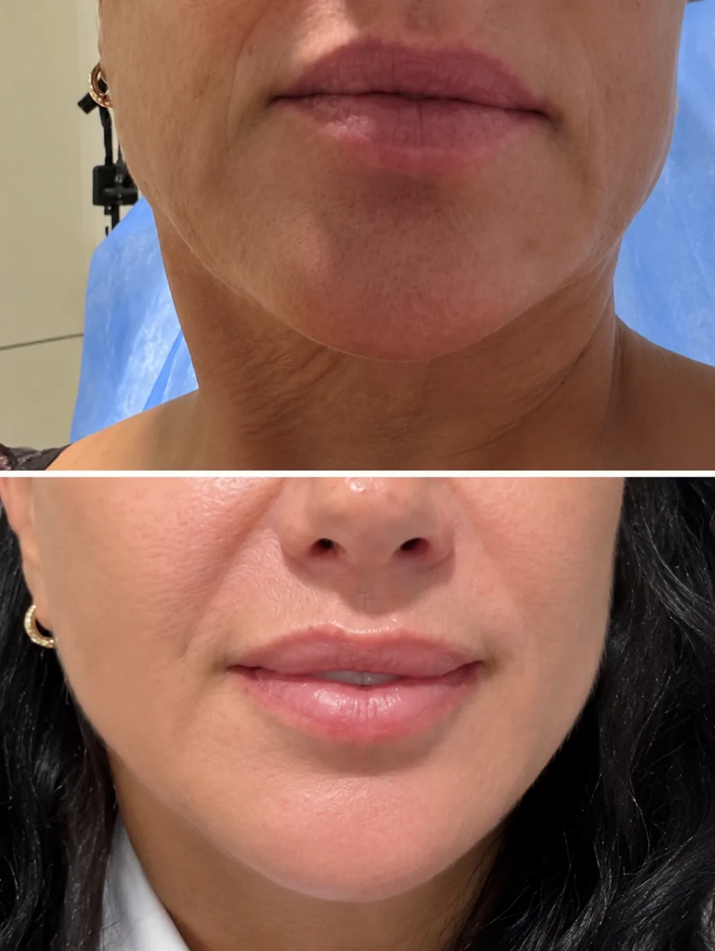 Endolift before and after — Jawline definition